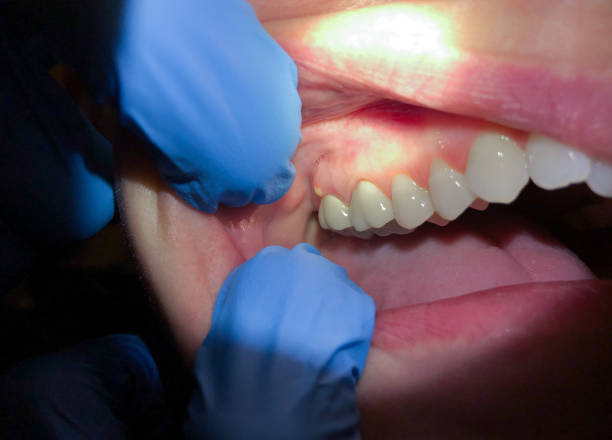 Best Emergency Treatment for Dental Infections or Abscesses in Louisville, KY